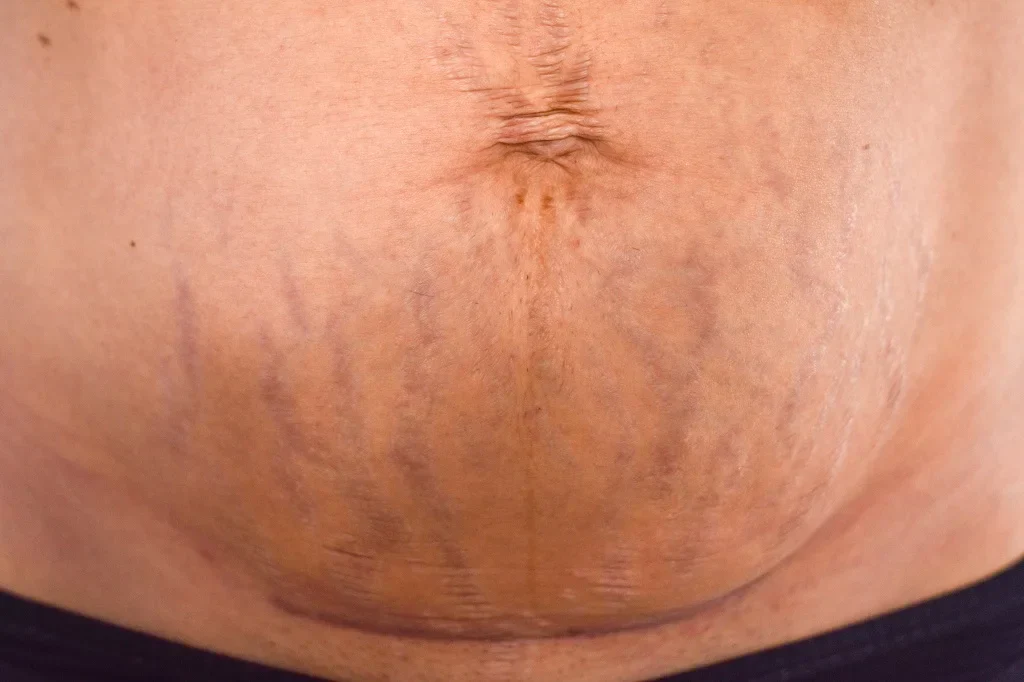 Purple Stretch Marks TATTOO GUIDE