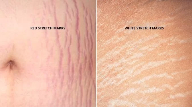 Can You Tattoo Over Stretch Marks?